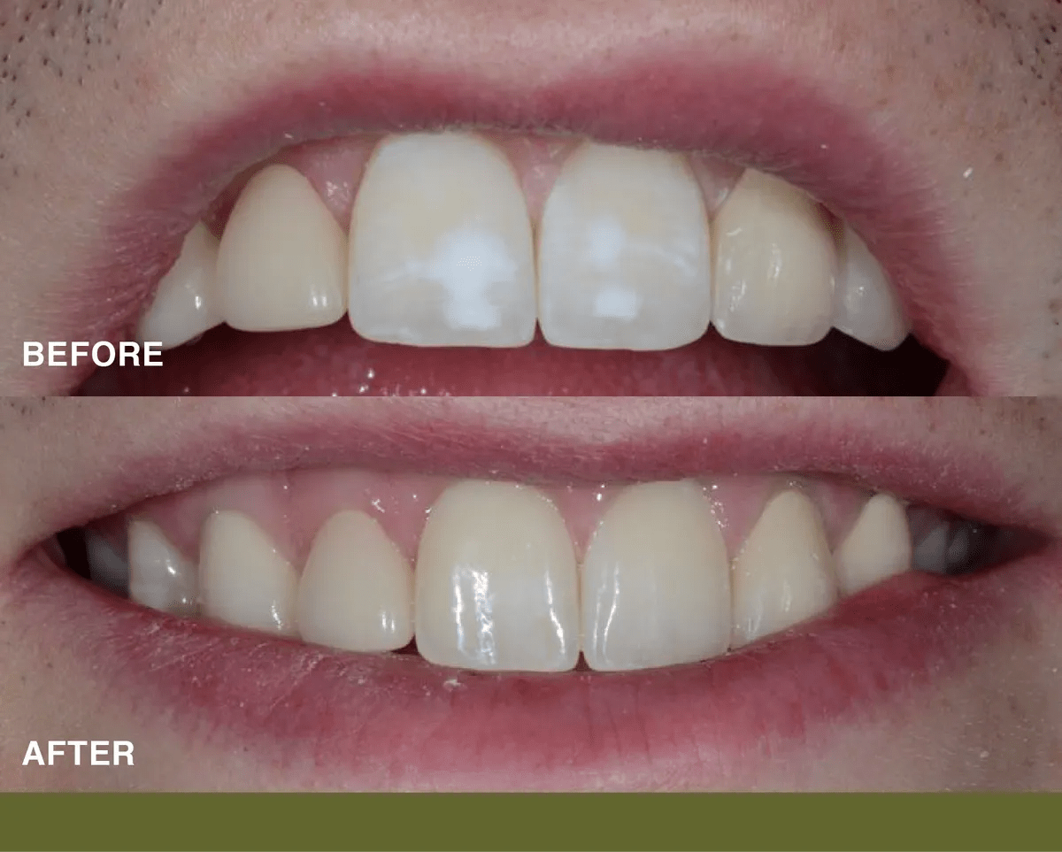 ICON Resin Infiltration White Spot Treatment For Teeth